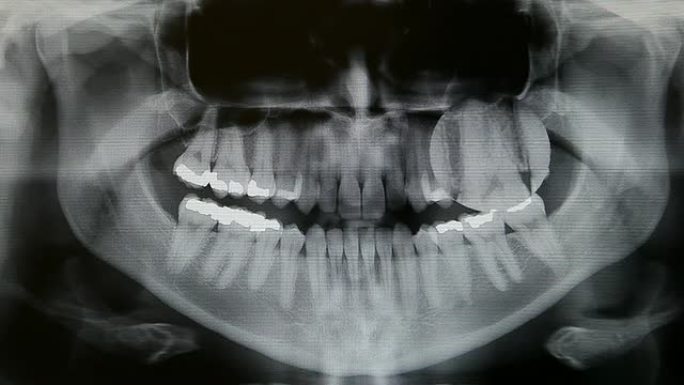 数字化牙科全景X射线放大