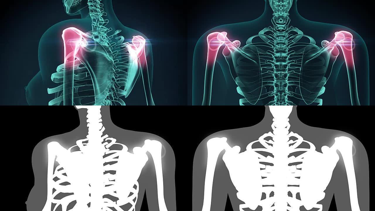 肩部疼痛的3D插图，医学概念动画。