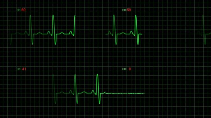 心电图心脏监测仪心电图心脏监测仪