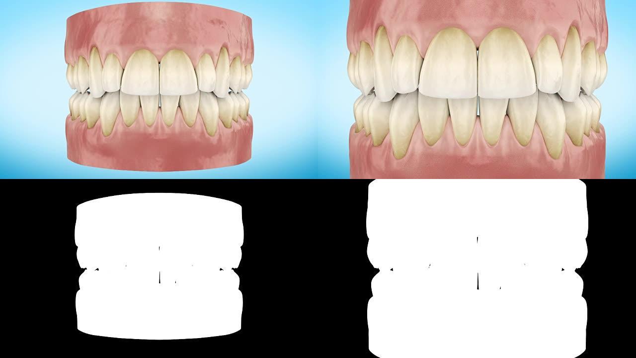 肮脏的黄色牙齿放大特写3d动画。阿尔法通道。