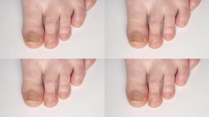 特写: 真菌感染的银屑病脚趾甲增厚的足部细节
