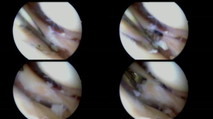 使用剃须刀进行关节镜下半月板手术