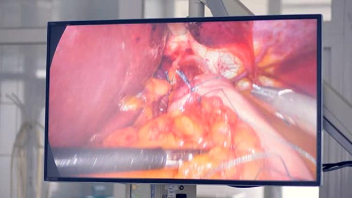 屏幕显示了外科医生如何在现代诊所使用医疗机器人。创新医学概念。