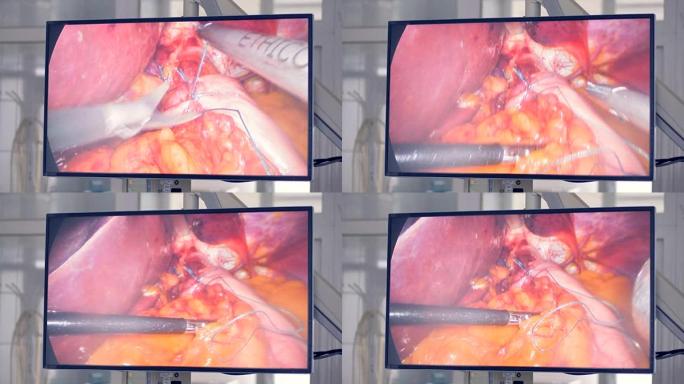屏幕显示了外科医生如何在现代诊所使用医疗机器人。创新医学概念。