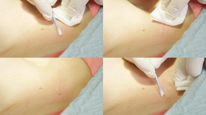 皮肤外科手术后的小伤口的特写消毒