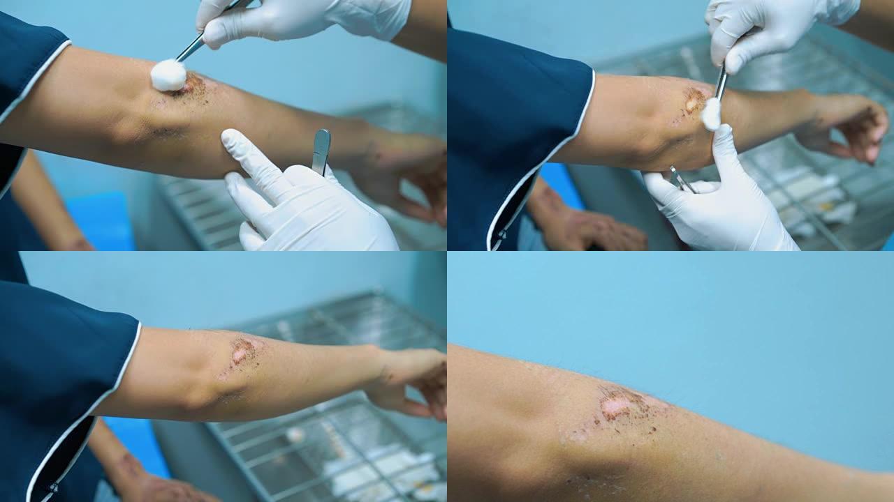4K四次医生清洁病人手臂上的伤口