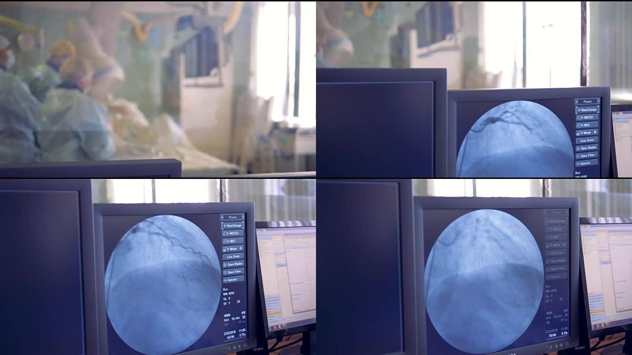 手术实时信息显示在计算机屏幕上。心脏手术概念。在手术室中，外科医生对患者进行操作。