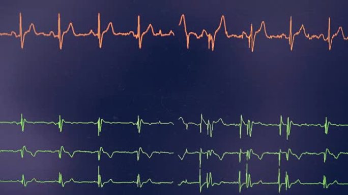 真正的心电图。心电仪示波器在屏幕上显示心率。