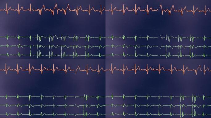 真正的心电图。心电仪示波器在屏幕上显示心率。