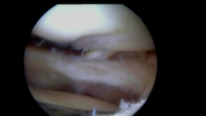 带撕裂器的膝关节镜检查