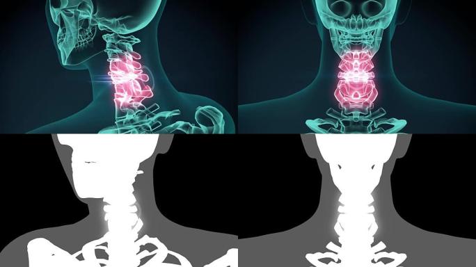 痛苦的脖子的3d渲染插图。医学概念动画。
