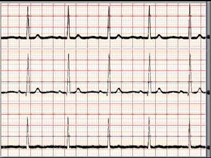 普通心电图3通道-NTSC