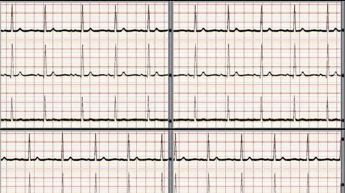 普通心电图3通道-NTSC