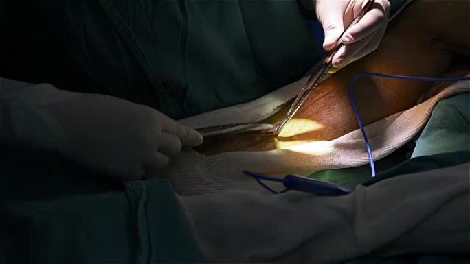 外科医生采集静脉进行冠状动脉旁路移植术