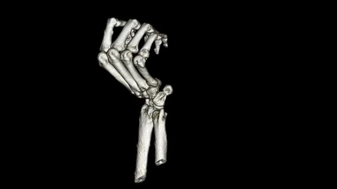 手部Cat扫描骨骼检查分析