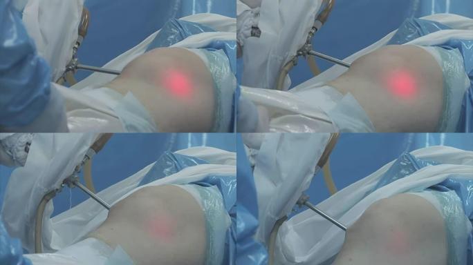 膝盖手术动手术膝盖