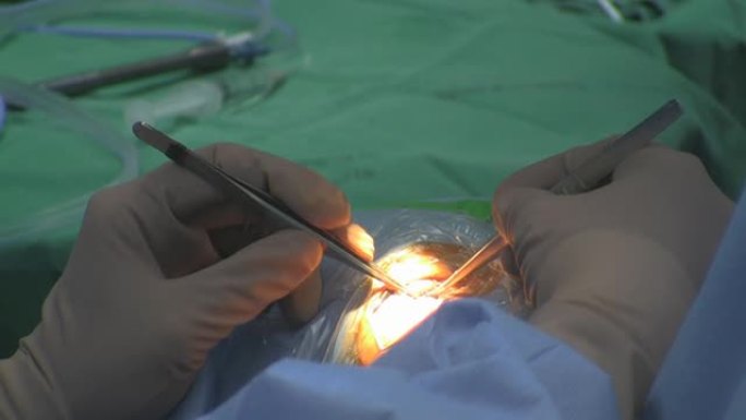 手术眼手术过程外科手术整容手术