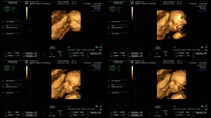 妊娠4D超声扫描b超