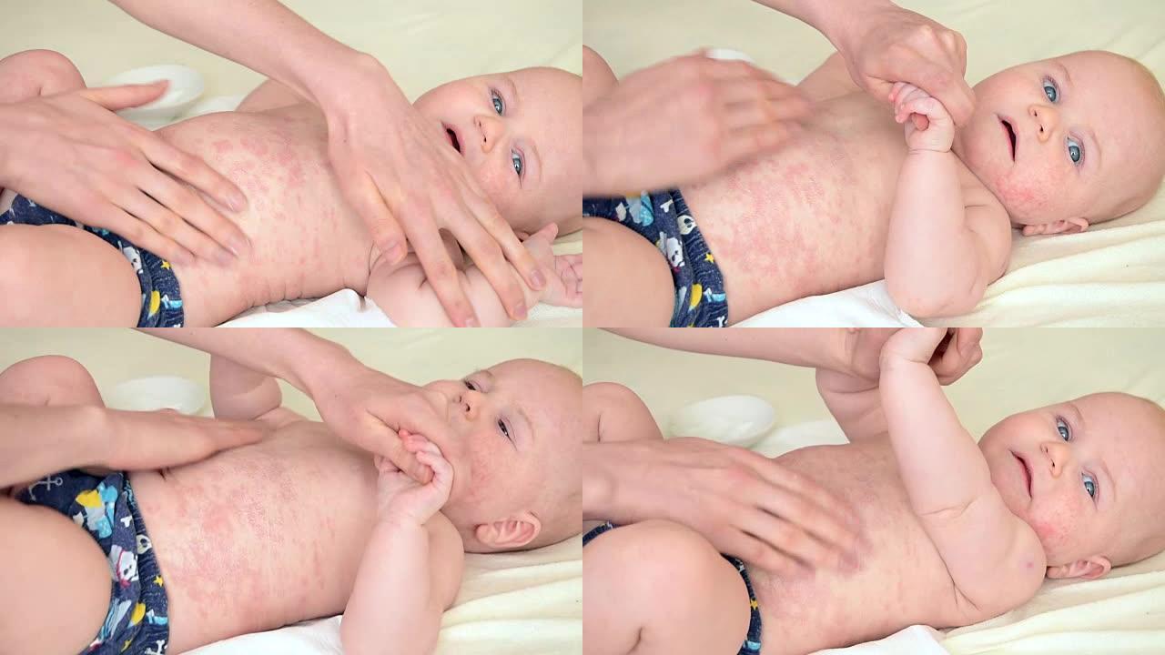具有素质的婴儿身患皮疹婴幼儿新生儿