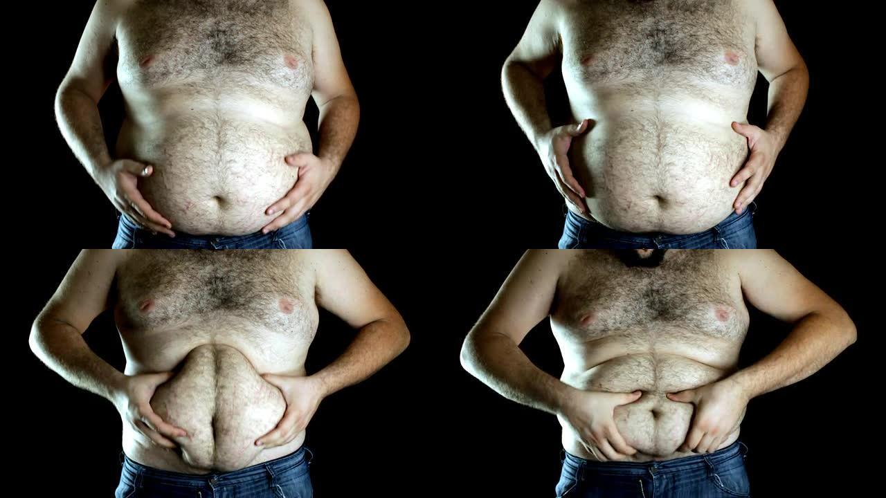 超重男子露出肚子肥胖症脂肪堆积大肚腩特写