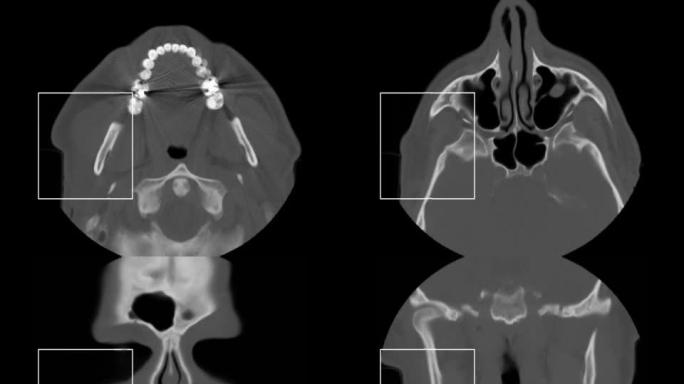 头部和鼻子MINI CT扫描