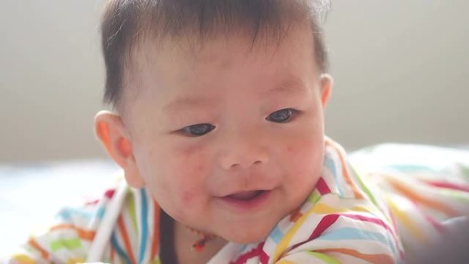 第5个月宝宝儿童小孩幼童皮肤病