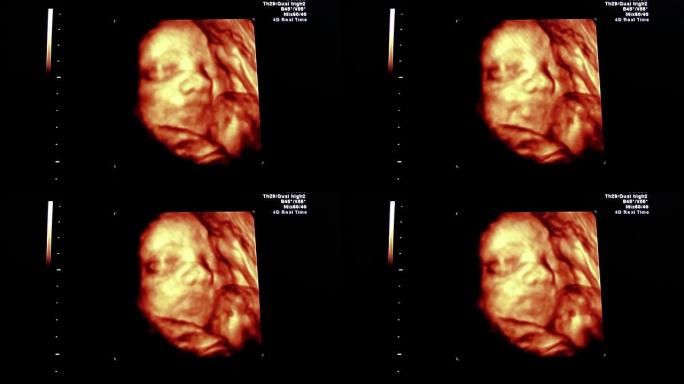 超声波三维超声波三维孕妇怀孕胎儿