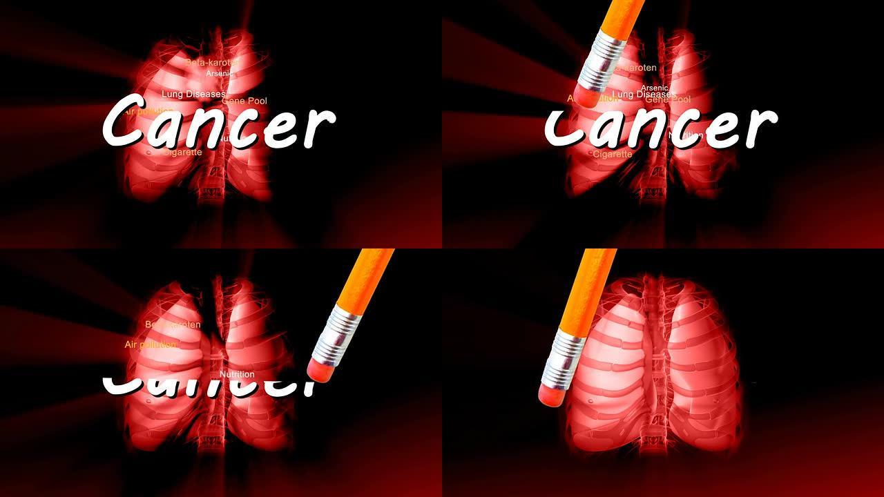 无癌症-HD肺癌晚期治疗消除动画特效素材
