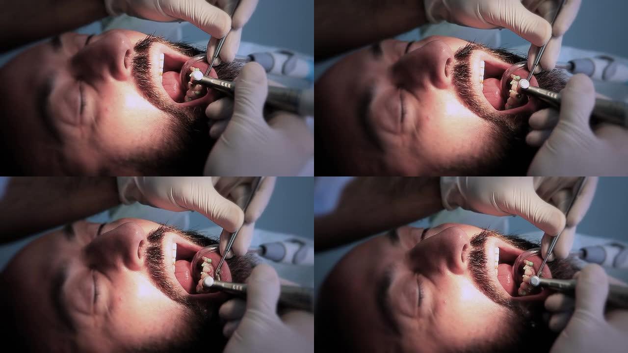 牙科治疗清洗牙垢口腔保养特写镜头