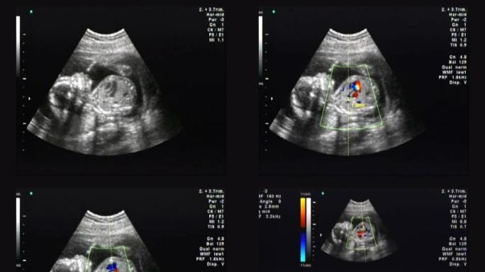 人类婴儿的超声波检查