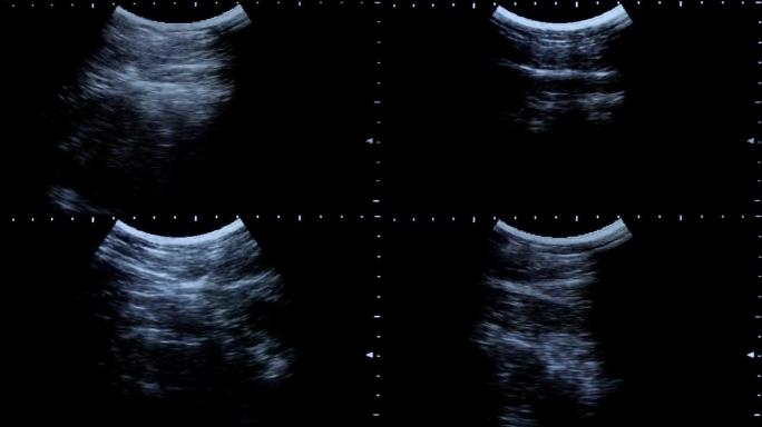 腹部超声检查腹部超声检查