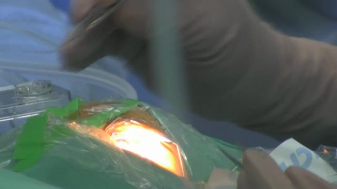 手术眼微创手术外科手术手术过程