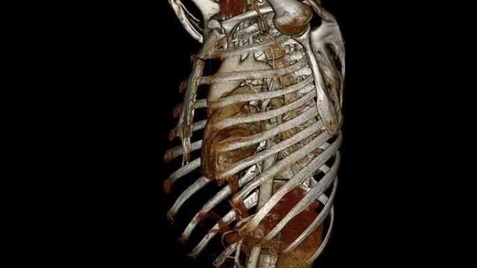 心脏CT血管造影与胸部
