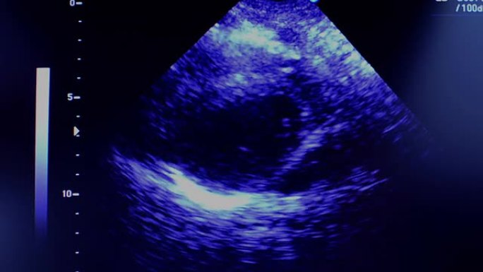超声波超声波胎儿、怀孕