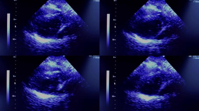 超声波超声波胎儿、怀孕