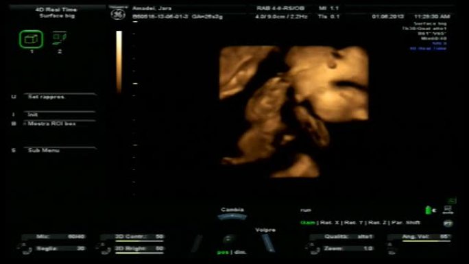 妊娠4D超声B超声波检查孕检影像屏幕医院
