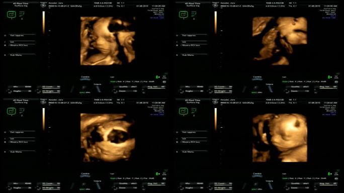 妊娠4D超声B超声波检查孕检影像屏幕医院