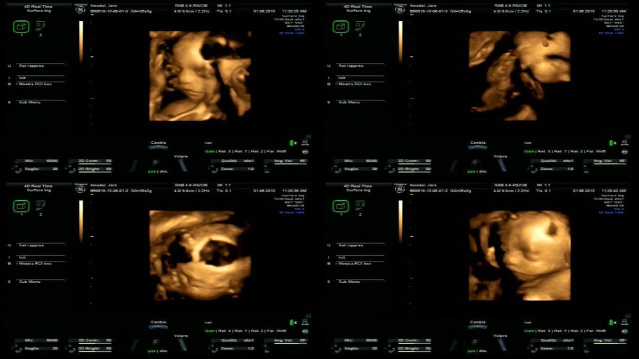 妊娠4D超声B超声波检查孕检影像屏幕医院