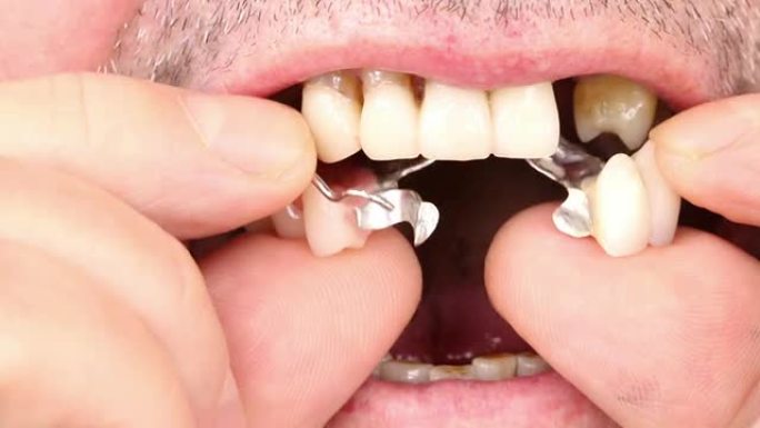 义齿的插入义齿的插入种植牙假牙