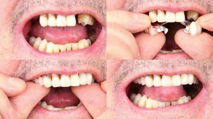 义齿的插入义齿的插入种植牙假牙
