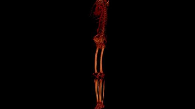 下肢多探测器CT血管造影
