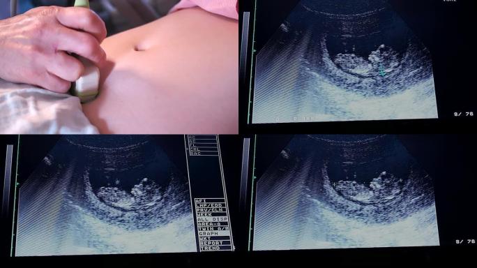 超声波孕妇定期孕检