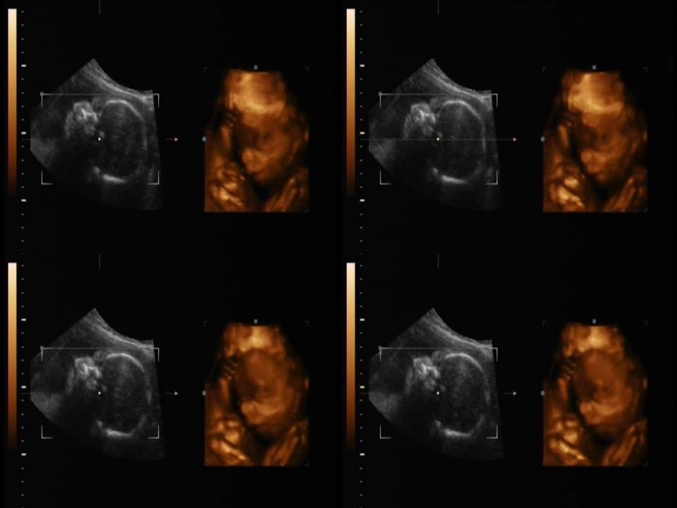 人类婴儿的超声波检查