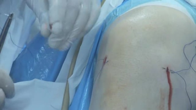 膝盖手术膝盖手术医疗缝线