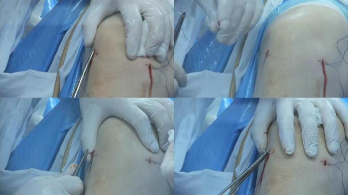 膝盖手术膝盖手术医疗缝线