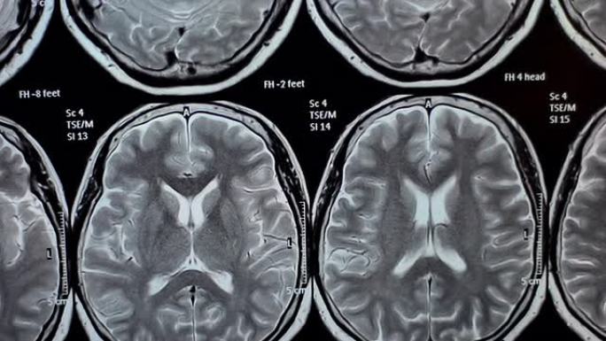 MRIMRI核磁共振成像头部CT平扫图医