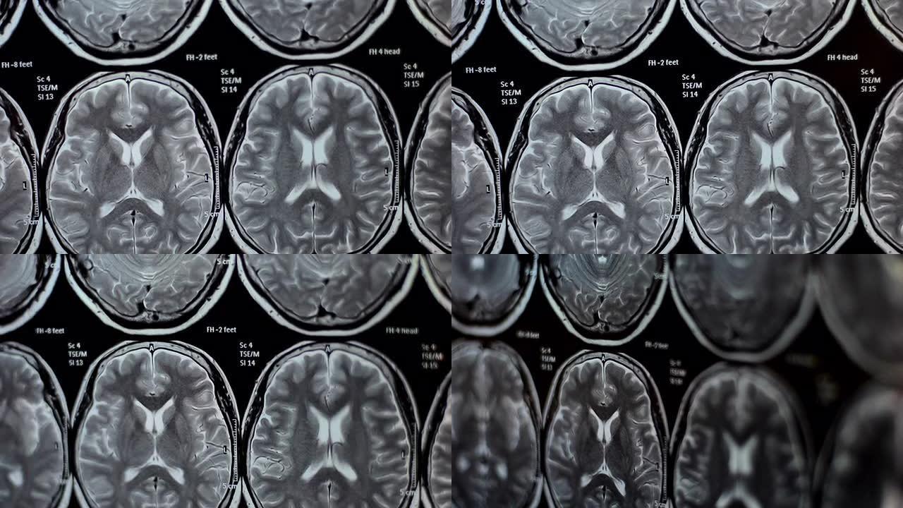 MRIMRI核磁共振成像头部CT平扫图医