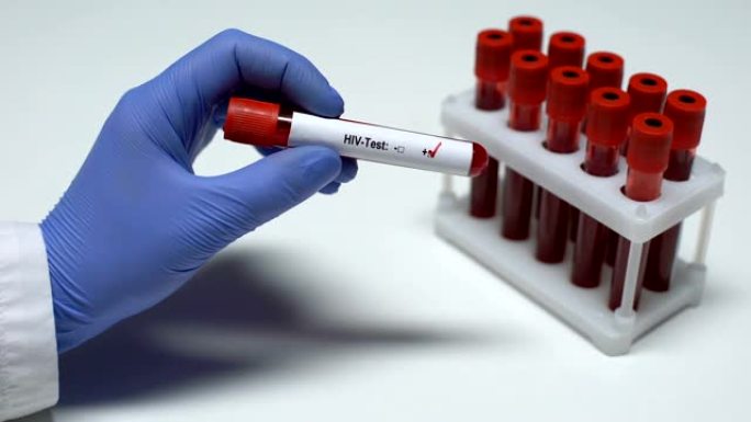 HIV检测阳性，医生显示血液样本，实验室研究，健康检查
