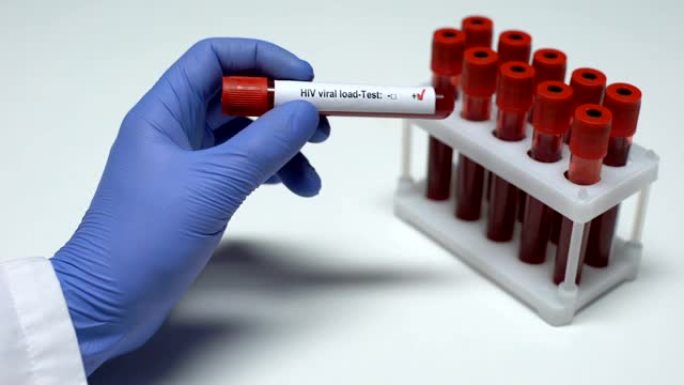 HIV病毒载量测试阳性，医生在试管中显示血液样本，实验室研究