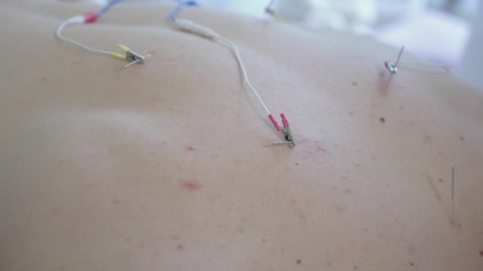 用插入的针灸针和连接的电气设备对男性高加索人背部进行特写。无法识别的人的电针。肌肉疼痛的愈合，替代疗